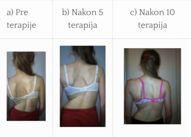 Skolioza – pacijent pre i posle terapije delfin spravom u centru za skoliozu