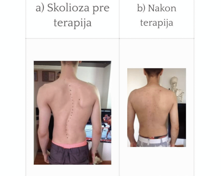 Posledice skolioze – pacijent pre i posle lečenja u centru za skoliozu, poboljšano držanje i smanjen bol u leđima