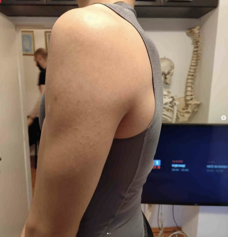 Deformitet kičmenog stuba - fizioterapija i terapije skolioze