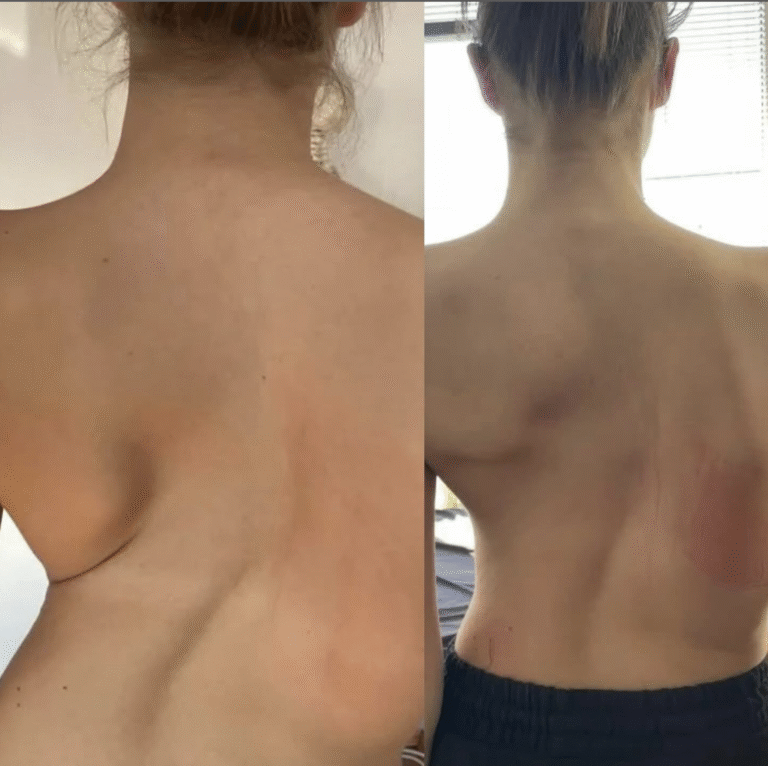 Deformitet kičmenog stuba – pacijent pre i posle fizioterapije i terapije skolioze