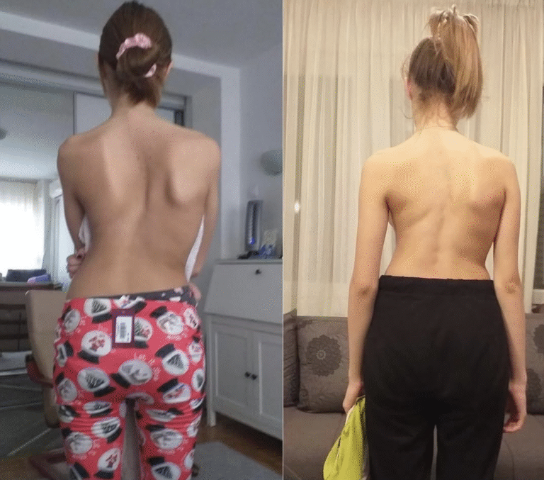 Vežbe za skoliozu kod odraslih – pacijent pre i posle terapije i korekcije kičme