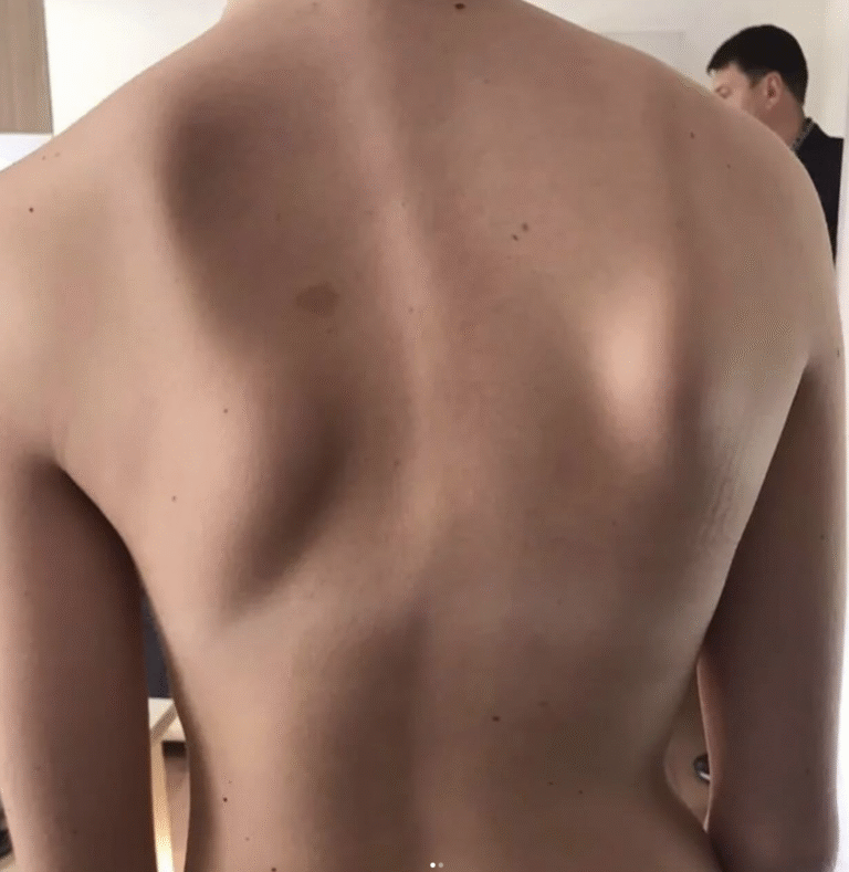 Pacijent sa skoliozom – vežbe za ispravljanje kičme u centru za skoliozu