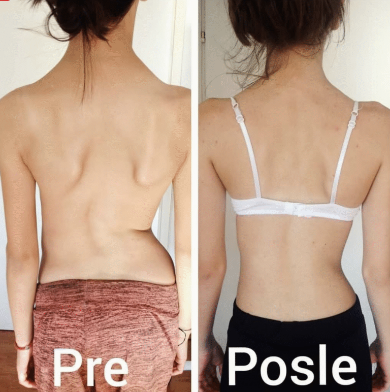 Skolioza kičmenog stuba – korekcija pre i posle vežbi i terapije u centru za skoliozu