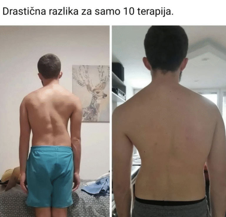 Pacijent sa skoliozom – prikaz pre i posle terapije u centru za skoliozu, vežbe za ispravljanje kičme