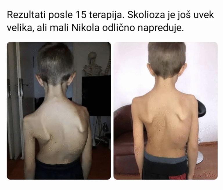 Ispravljanje kičme – pacijent pre i posle fizioterapije skolioze i vežbi za skoliozu