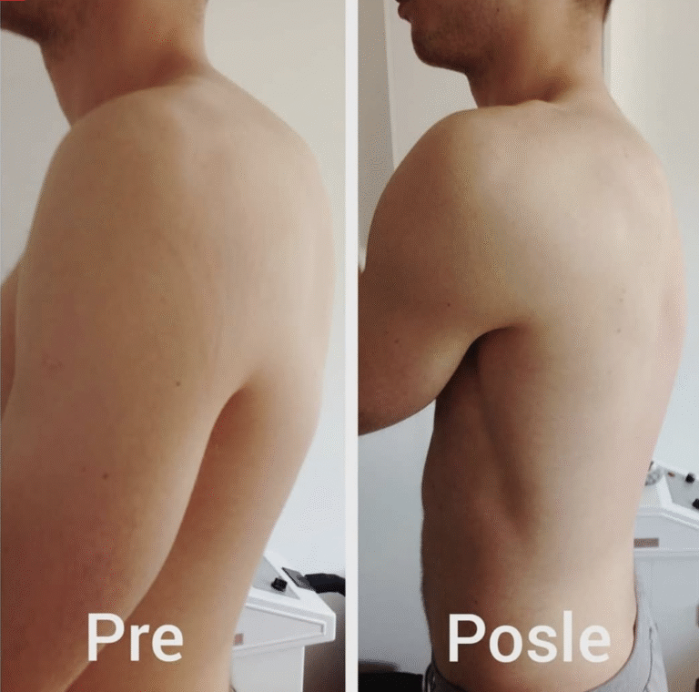 Posledice skolioze – pacijent pre i posle lečenja u centru za skoliozu, poboljšano držanje i smanjen bol u leđima