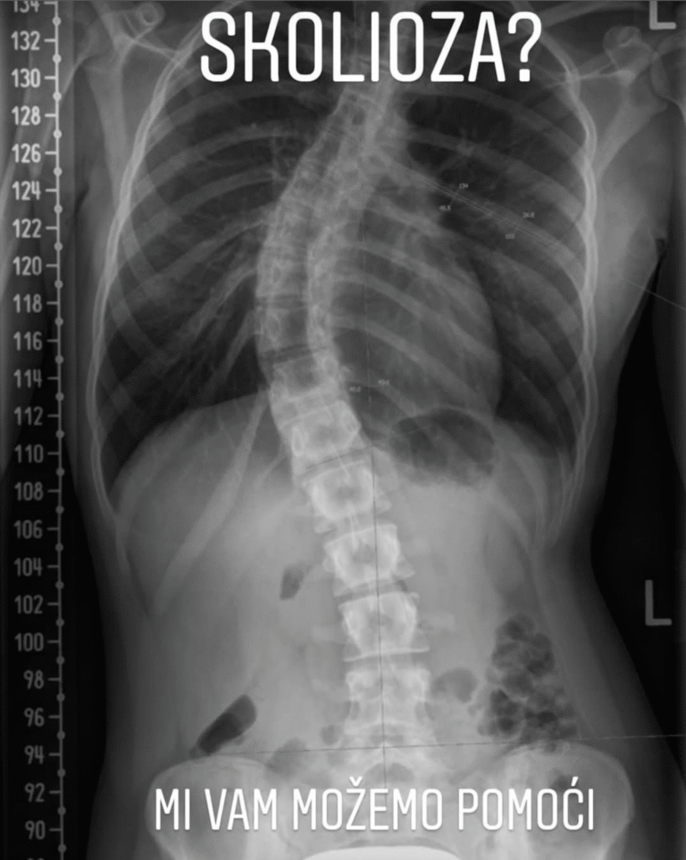 Terapija skolioze – vidljiva korekcija deformiteta kičmenog stuba