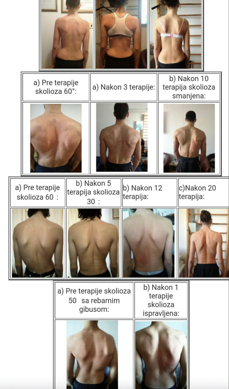 Skolioza – pacijent pre i posle terapije delfin spravom u centru za skoliozu