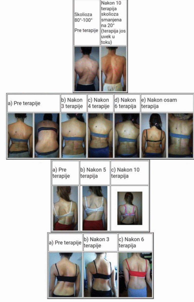 Deformitet kičmenog stuba – pacijent pre i posle fizioterapije i terapije skolioze