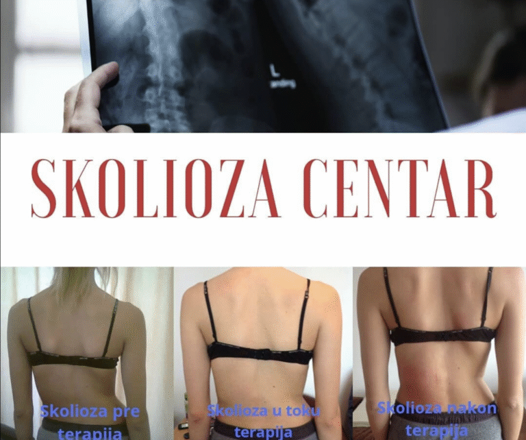 Skolioza – fizioterapija i vežbe za pacijente svih uzrasta