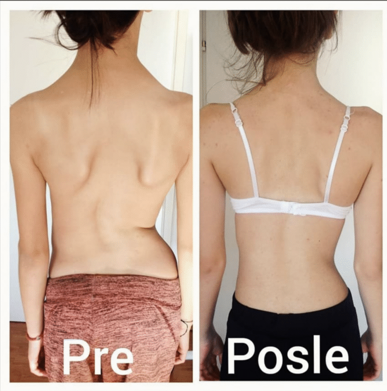 Pacijent tokom terapije skolioze – individualni pristup i vežbe za kičmu